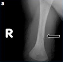 X ray of a toddler witha spiral fracture of the femur bone